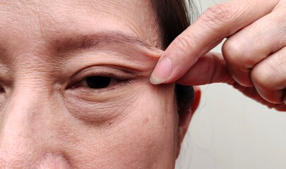 Portrait the fingers holding the flabbiness adipose sagging skin beside the eye, ptosis and...