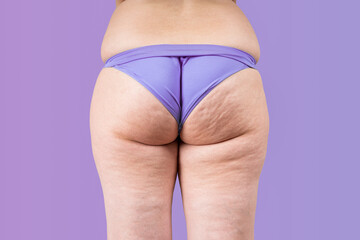 Overweight thigh, woman with fat hips and buttocks, obesity female body with cellulite on purple background - obrazy, fototapety, plakaty
