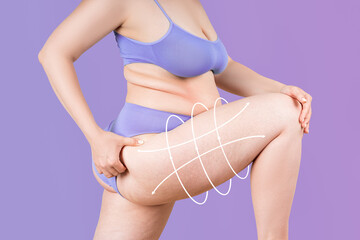 Legs and buttocks liposuction, fat and cellulite removal concept, overweight female body with...