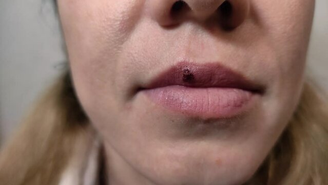 Bloody herpes wound on woman lips	