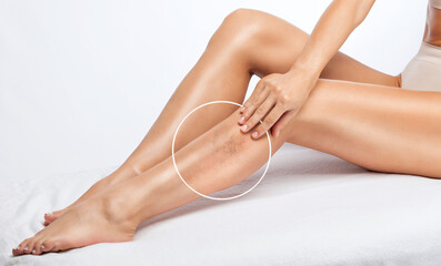 The woman shows the dilation of small blood vessels of the skin on the leg. Medical inspection and...