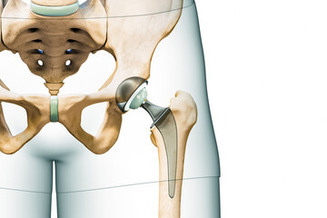 Hip prosthesis or implant isolated on white background with copy space and body contours. Hip joint or femoral head replacement 3D rendering illustration. Medicine, surgery, science concepts. - obrazy, fototapety, plakaty