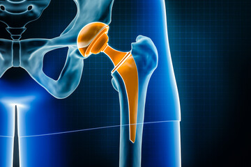 Hip prosthesis x-ray 3D rendering illustration. Total hip joint replacement surgery or arthroplasty, medical and healthcare, arthritis, pathology, science, osteology, orthopedics concepts. - obrazy, fototapety, plakaty