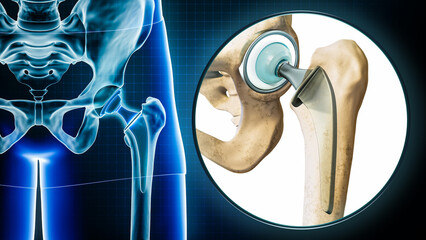 Femoral head hip prosthesis or implant x-ray with magnification or close-up. Total hip joint replacement surgery or arthroplasty 3D rendering illustration. Medical and healthcare, science concepts. - obrazy, fototapety, plakaty