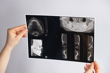 The doctor holds a CT scan of a patient with temporomandibular joint dysfunction and malocclusion.