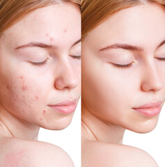 Young woman before and after acne treatment.