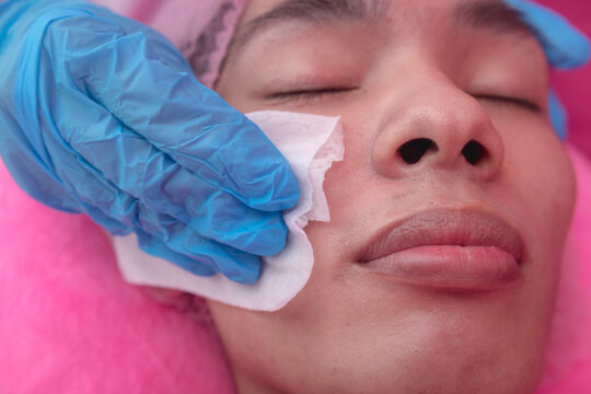 Cleaning the cheeks of a client with wet wipes, removing oil, makeup, and other residue prior to a facial procedure. At a facial care and dermatology clinic.