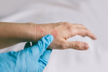 Doctor in blue gloves examines on hands with redness rash. Cause of itchy skin include dermatitis (eczema), dry skin, burned, food, drug allergies, insect bites. Health care concept.