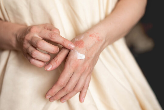 Itching on hands with redness rash. Cause of itchy skin include dermatitis (eczema), dry skin, burned, food,drug allergies, insect bites. Health care concept.