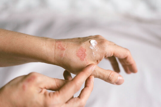 Itching on hands with redness rash. Cause of itchy skin include dermatitis (eczema), dry skin, burned, food,drug allergies, insect bites. Health care concept.
