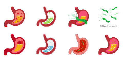 Vector Collection of illustrations human anatomy, stomach with pills, with heartburn, gases, helicobacter pylori, stomach ulcer.