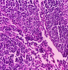 Caecum lymph node biopsy: Chronic nonspecific lymphadenitis. Photomicrograph show lymph node, features of reactive change.