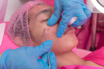 An esthetician uses a blackhead extractor or comedone to remove and push out clogged sebum from the...