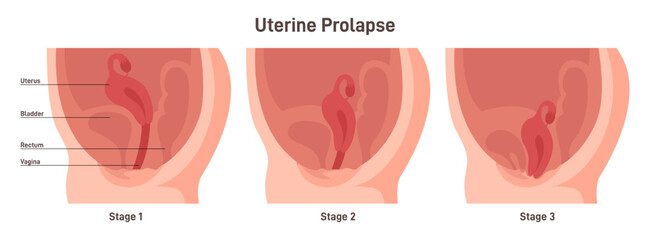 Stages of uterine prolapse. Pelvic floor muscles weakening, Support