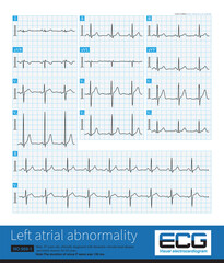 In clinic, mitral stenosis is a common organic heart disease that leads to left atrium abnormality in ECG. The duration of sinus P wave widens by more than 120ms.
