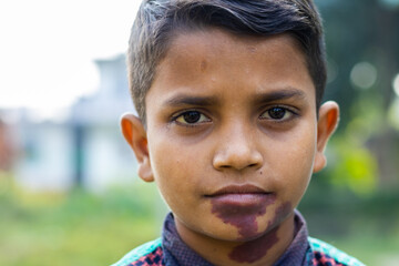 Melanoma dark skin birthmark on face of young Asian boy