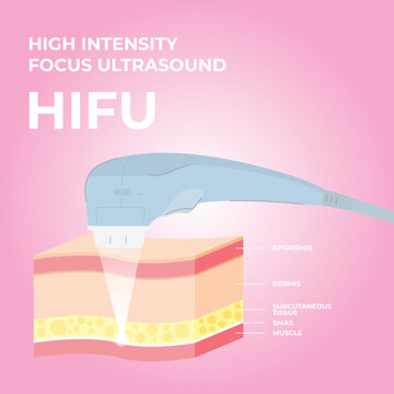 HIFU Spa Treatment. High Intensity Focus Ultrasound. SMAS Ultrasound Face Lifting With Hardware. Face Saggy Skin Treat. Cell Body Lift. Double Chin Lift. Facial Medical Procedure. Cutaway Skin Diagram