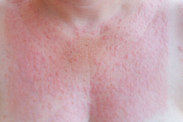 on the female breast a lot of red small pimples