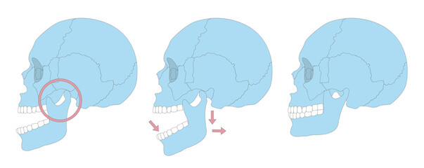 dislocation skull vector illustration - obrazy, fototapety, plakaty