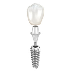 Dental implant and ceramic crown. Medically accurate tooth 3D illustration. - 544542771