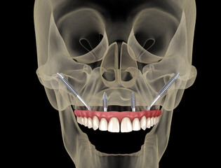 Maxillary prosthesis supported by zygomatic implants. Medically accurate 3D illustration of human teeth and dentures