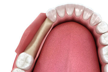 Open flap procedure, bone lose. Medically accurate 3D illustration - obrazy, fototapety, plakaty