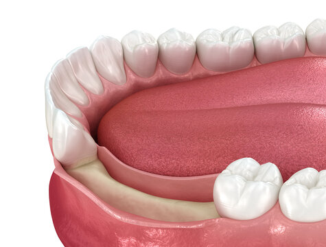 Open flap procedure, bone lose. Medically accurate 3D illustration