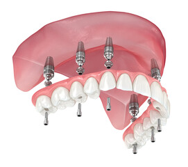 Maxillary prosthesis with gum All on 6 system supported by implants. Dental 3D illustration - 544543566