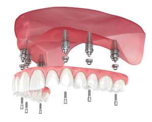 Maxillary prosthesis with gum All on 6 system supported by implants. Dental 3D illustration - obrazy, fototapety, plakaty