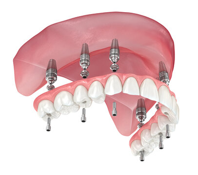 Maxillary prosthesis with gum All on 6 system supported by implants. Dental 3D illustration