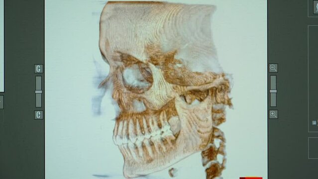 CT scan of a patient with malocclusion, missing tooth and temporomandibular joint dysfunction.