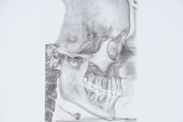 CT scan of a patient with malocclusion, missing chewing tooth and temporomandibular joint dysfunction.