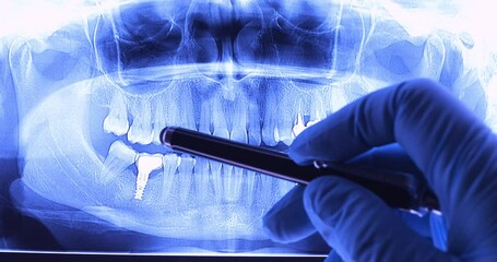 Doctor analyzing dental x-ray with implants. Radiography for dental structures research concept. Dolly shot 4k