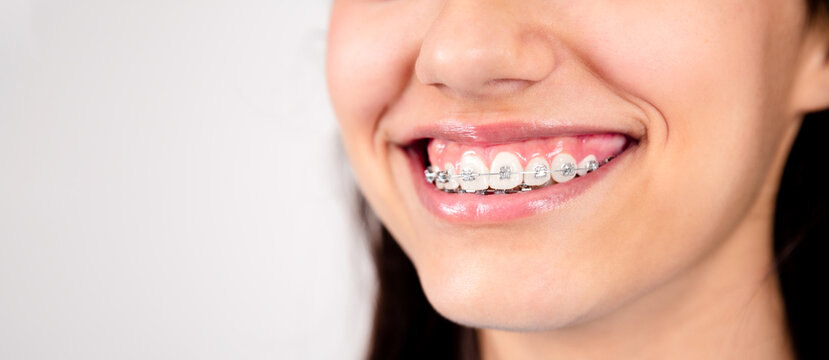 Smile of a teen girl with metal braces