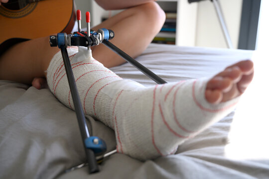 Woman with External fixation right tibial fracture