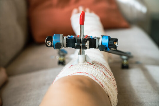 woman with External fixation right tibial fracture