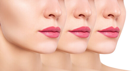 Female lips after augmentation and correcting the shape of the lips.
