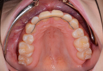 retainer im oberkiefer nach regulierung der zähne