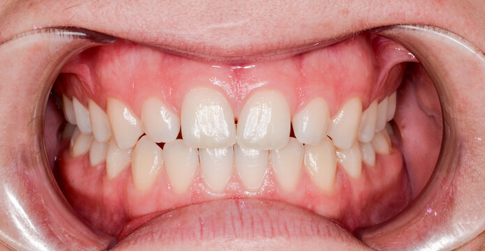 gesundes gebiss, frontalansicht