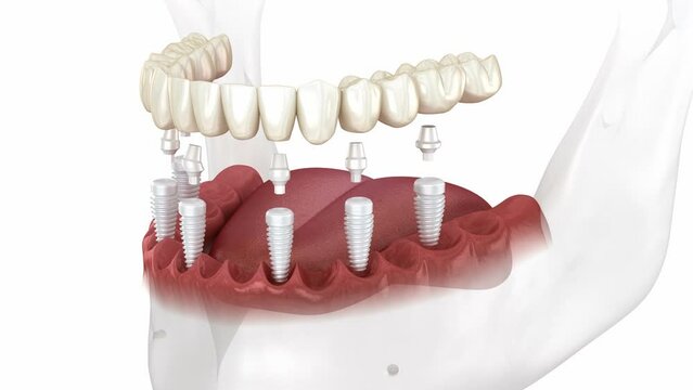 Dental prosthesis based on 6 ceramic implants. Dental 3D animation
