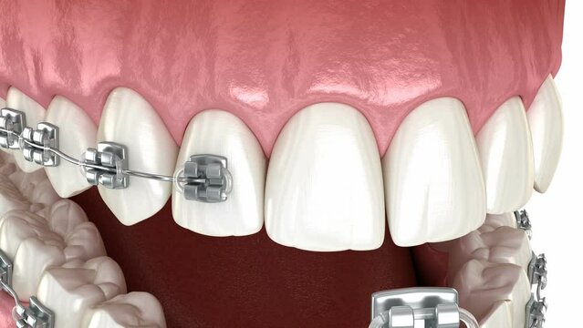 Dental braces placement, orthodontic treatment. Dental 3D animation