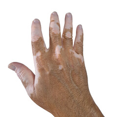 Hand with vitiligo on transparent isolated png background