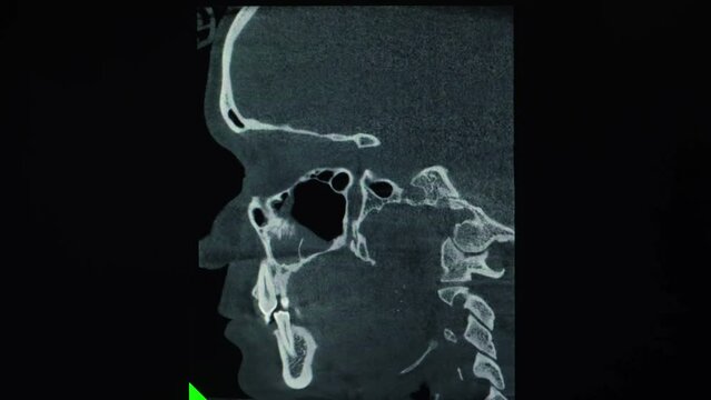 CT scan of a patient with malocclusion, missing tooth and temporomandibular joint dysfunction.