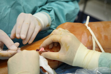 Preparing the patient for phlebectomy  surgery. Surgical field marking. Varicose veins surgery act,...