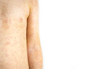 Rash on the child's body on a white background.