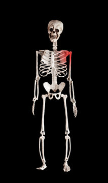 Shoulder pain, clavicle trauma, collarbone and acromion fracture, injury concept