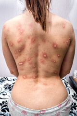 Allergy rash, Around Back view of human with dermatitis problem of rash ,Allergy rash and Health problem