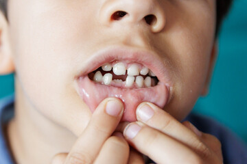 Fototapeta premium Child's mouth with dent due to fallen milk tooth