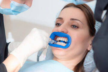 Preparing the oral cavity for whitening with an ultraviolet lamp. Close-up