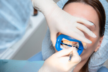 Preparing the oral cavity for whitening with an ultraviolet lamp. Close-up
